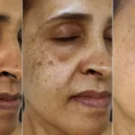 Pigmentation