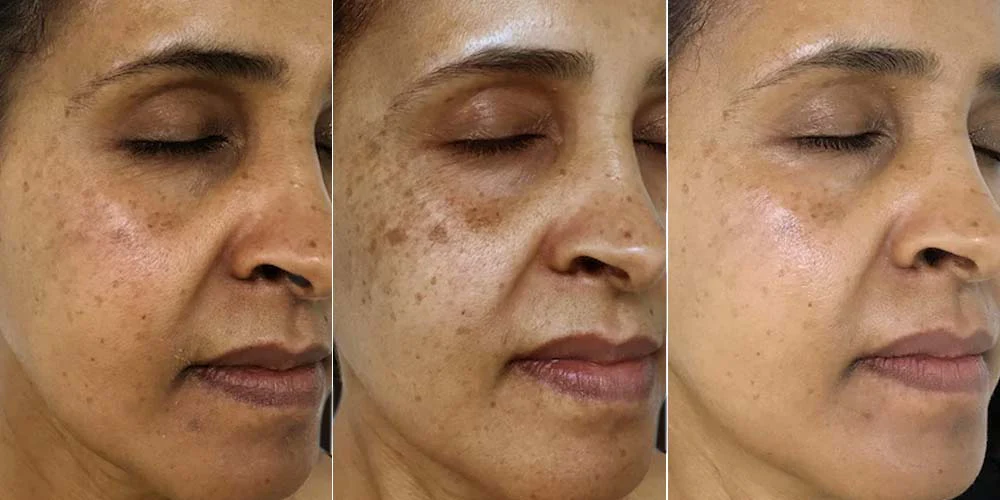 Pigmentation